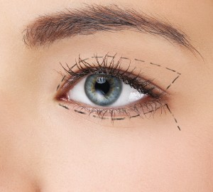 Los Angeles Eyelid Surgery