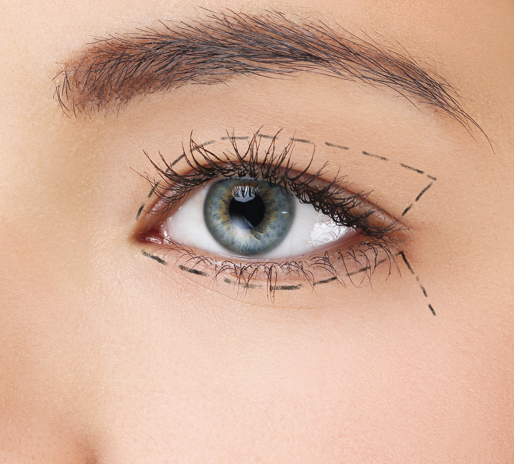 Newport Beach Eyelid Surgery