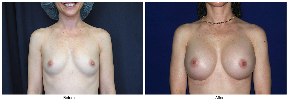 Before & After Breast Augmentation 1 – Front