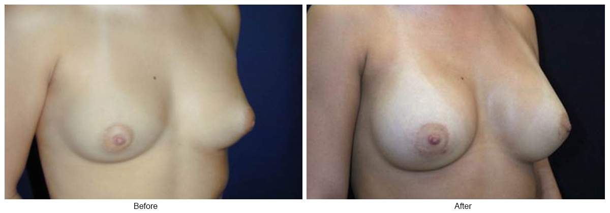 Before & After Breast Augmentation 11 – RQ