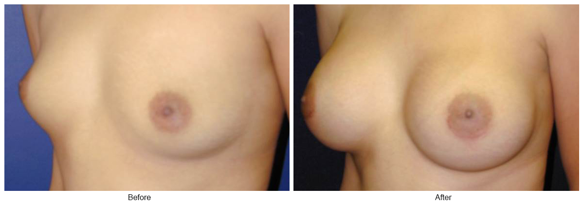 Before & After Breast Augmentation 13 – LQ