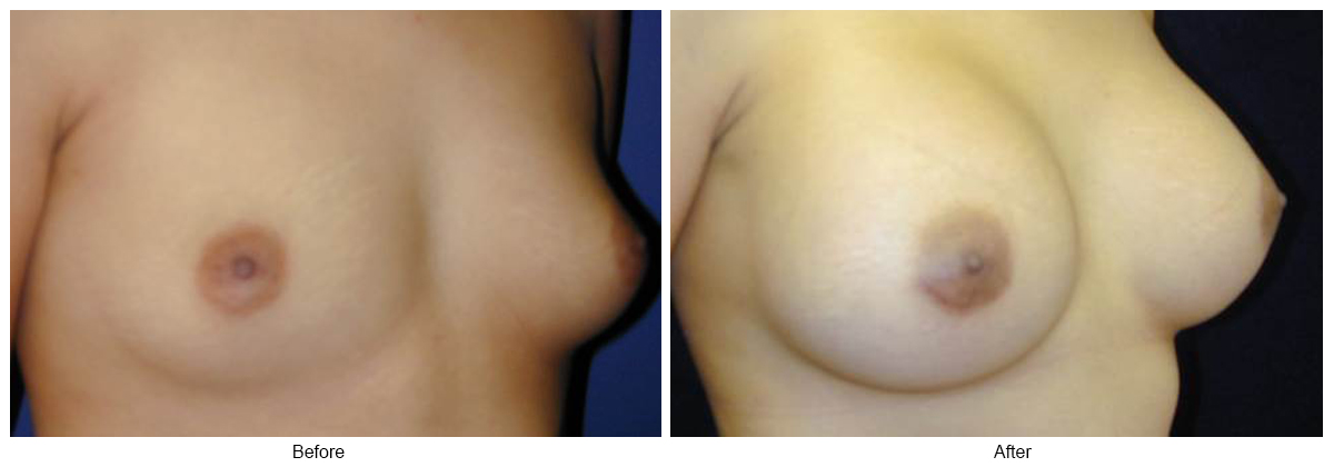 Before & After Breast Augmentation 13 – RQ