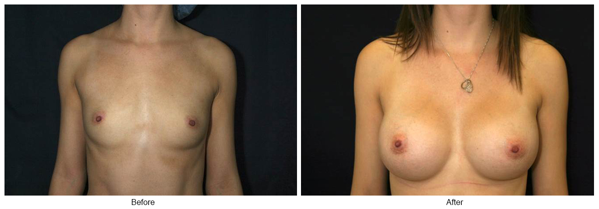 Before & After Breast Augmentation 2 – Front