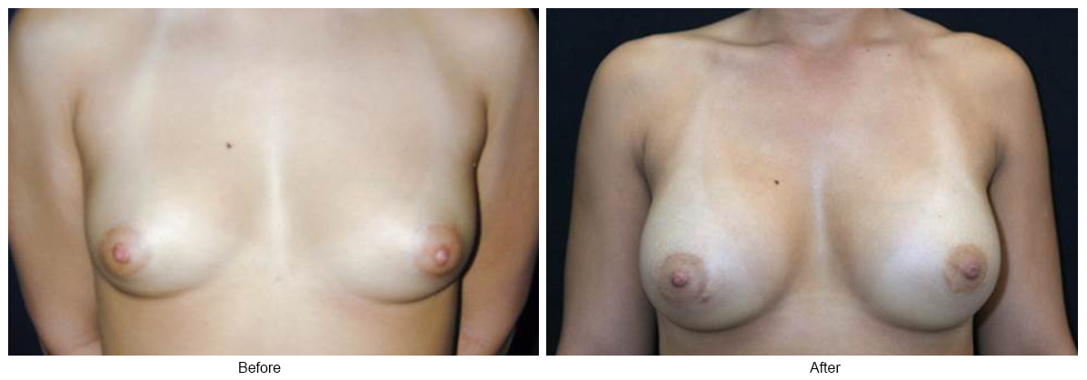 Before & After Breast Augmentation 3 – Front