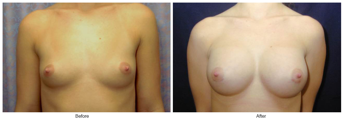 Before & After Breast Augmentation 4 – Front