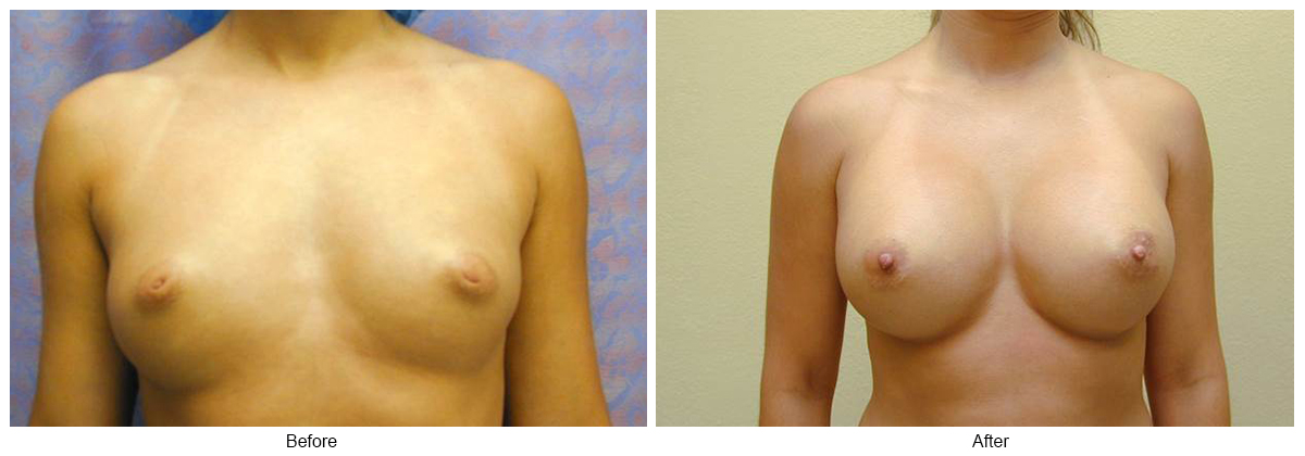 Before & After Breast Augmentation 5 – Front