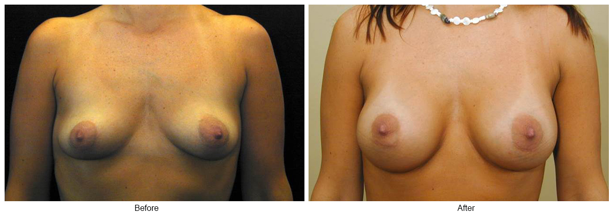 Before & After Breast Augmentation 6 – Front