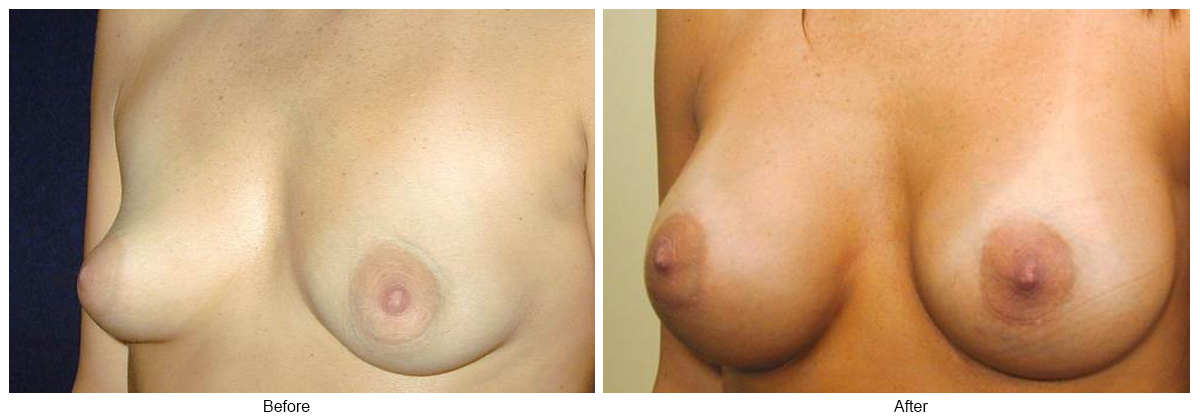 Before & After Breast Augmentation 6 – LQ