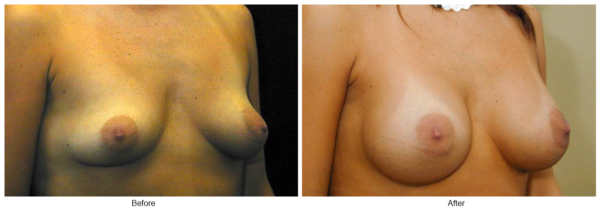 Before & After Breast Augmentation 6 – RQ