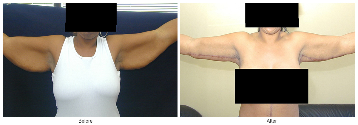 Before & After Arm Lift 1