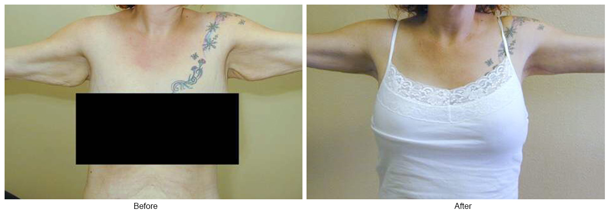 Before & After Arm Lift 3