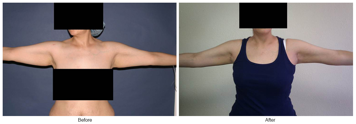 Before & After Arm Lift 4