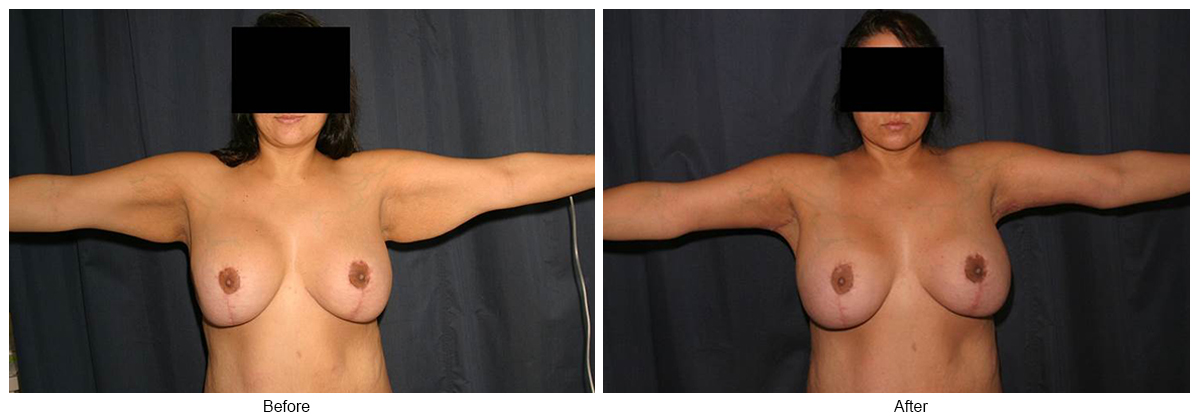 Before & After Arm Lift 5