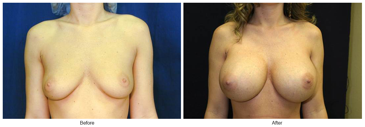 Before & After Breast Augmentation 8 – Front