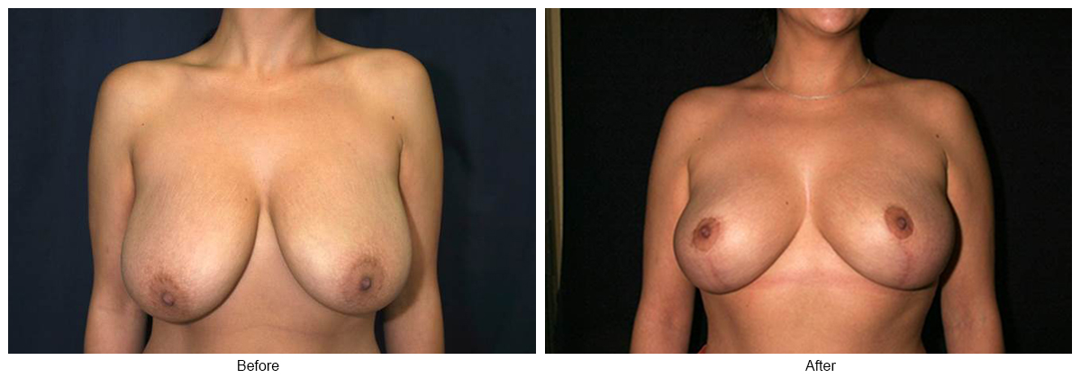 Before & After Breast Reduction 1 – Front