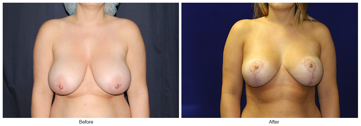 Before & After Breast Reduction 3 – Front