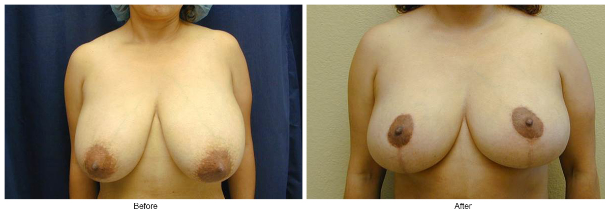 Before & After Breast Reduction 5 – Front