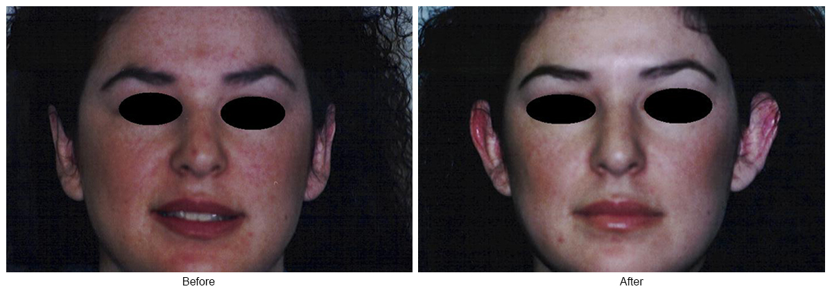 Before & After Otoplasty 3