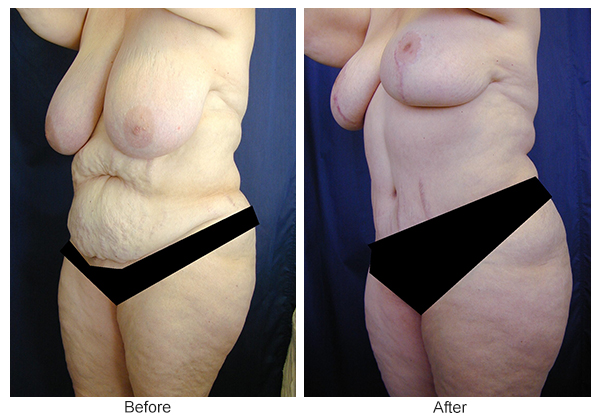 Before and After Body Lift 7 – LQ