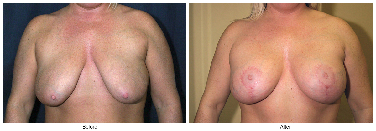 Before and After Breast Lift 1 – F