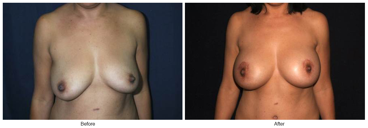 Before and After Breast Lift 4 – F