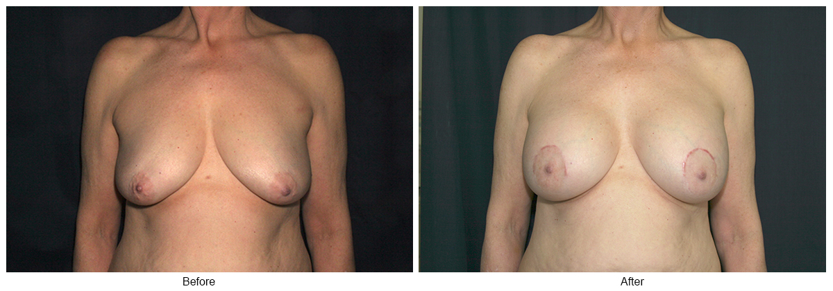 Before and After Breast Lift 5 – F