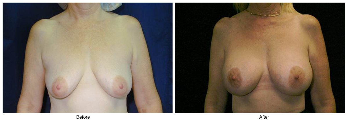 Before and After Breast Lift 6 – F