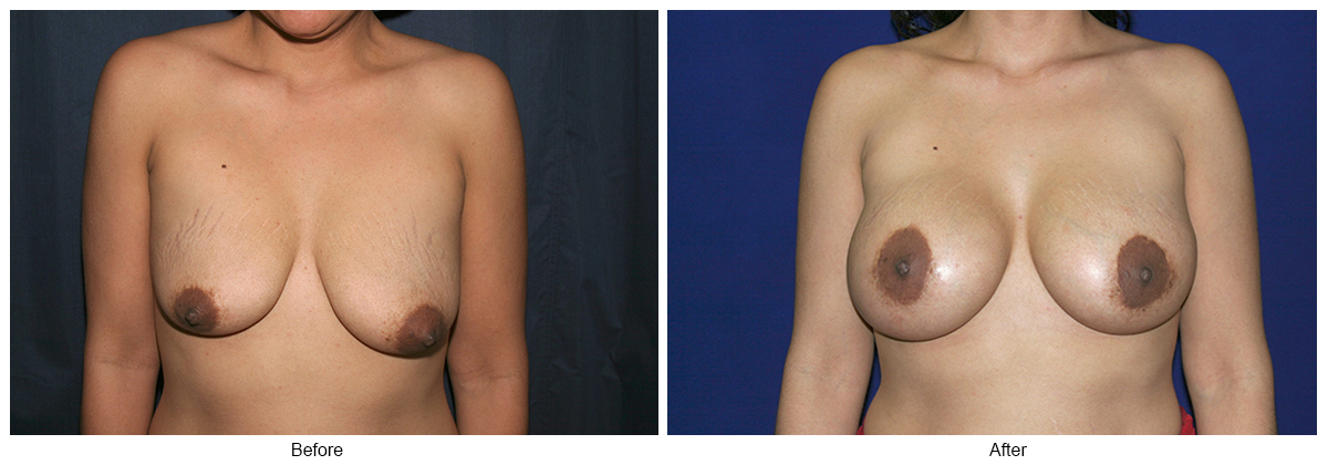 Before and After Breast Lift 7 – F