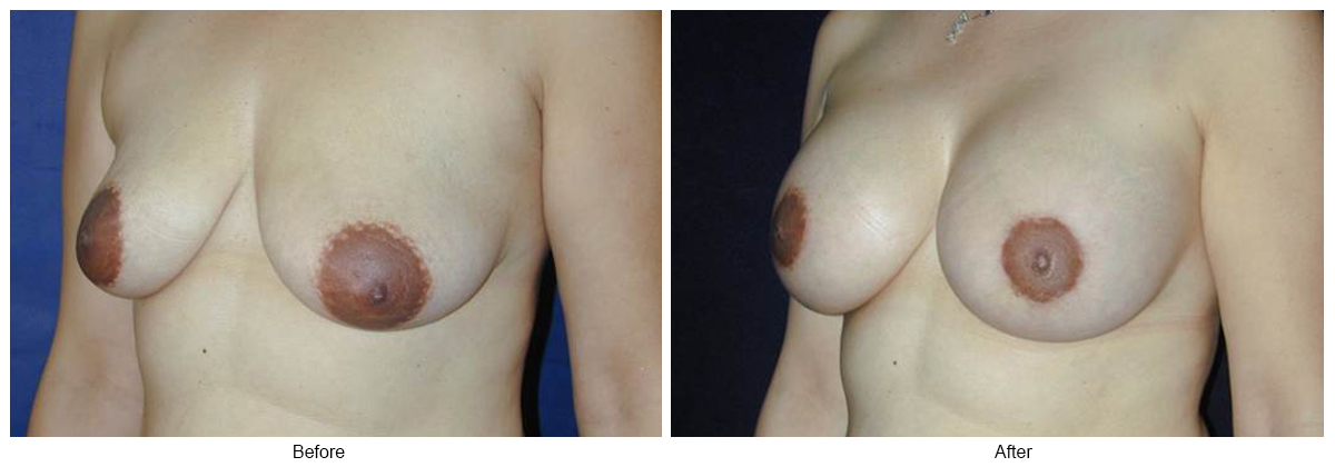 Before and After Breast Lift 9 – LQ