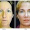 Orange County Cosmetic Surgery Clinique Before & After Facelift 4 - Front