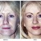 Orange County Cosmetic Surgery Clinique Before & After Facelift 5 - Front