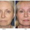 Orange County Cosmetic Surgery Clinique Before & After Facelift 6 - Front