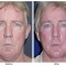 Orange County Cosmetic Surgery Clinique Before & After Facelift 7 - Front