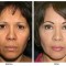 Orange County Cosmetic Surgery Clinique Before & After Facelift 8 - Front