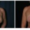 Orange County Cosmetic Surgery Clinique Before & After Anchor Lift 1 - Front