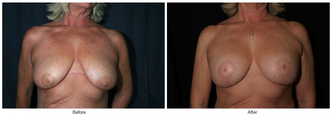 Orange County Cosmetic Surgery Clinique Before & After Anchor Lift 1 - Front