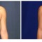 Orange County Cosmetic Surgery Clinique Before & After Anchor Lift 2 - Front