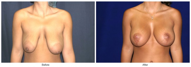 Orange County Cosmetic Surgery Clinique Before & After Anchor Lift 2 - Front