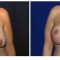 Orange County Cosmetic Surgery Clinique Before & After Anchor Lift 3 - Front