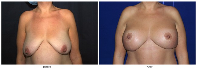 Orange County Cosmetic Surgery Clinique Before & After Anchor Lift 3 - Front