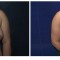 Orange County Cosmetic Surgery Clinique Before & After Anchor Lift 4 - Front