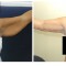 Orange County Cosmetic Surgery Clinique Before & After Arm Lift 1