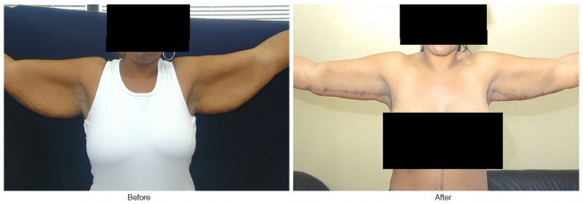 Orange County Cosmetic Surgery Clinique Before & After Arm Lift 1