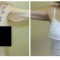 Orange County Cosmetic Surgery Clinique Before & After Arm Lift 3