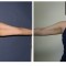 Orange County Cosmetic Surgery Clinique Before & After Arm Lift 4