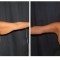 Orange County Cosmetic Surgery Clinique Before & After Arm Lift 5