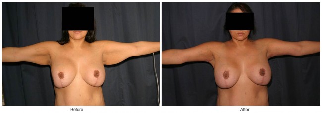 Orange County Cosmetic Surgery Clinique Before & After Arm Lift 5