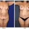 Orange County Cosmetic Surgery Clinique Before & After Body Lift 1 - Front