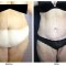 Orange County Cosmetic Surgery Clinique Before & After Body Lift 2 - Front