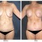 Orange County Cosmetic Surgery Clinique Before & After Body Lift 3 - Front